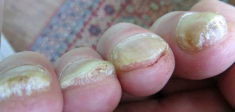 How to Treat Thick Toenails