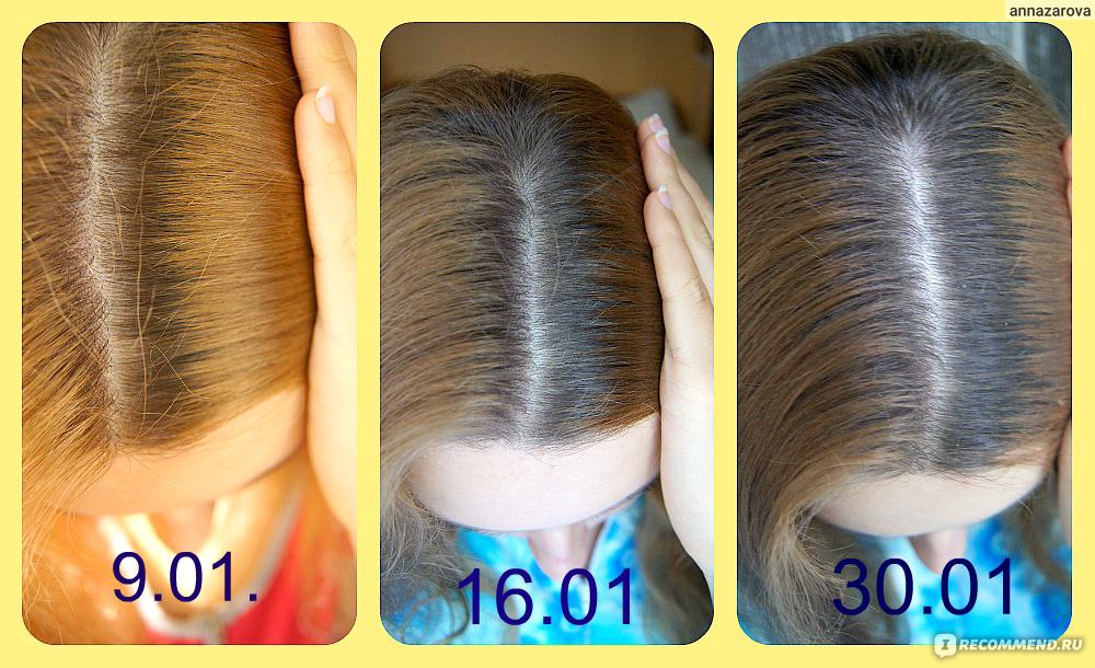 Сколько за месяц отрастают волосы на голове. Рост волос за месяц. Рост волос по месяцам. Волосы отрасли за год. Рост волос в месяц у женщин.
