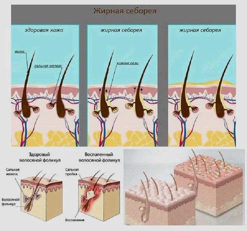 Кожное сало. Себорея волосистой кожи. Себорейный дерматит (или себорея).. Жирная себорея, себорейный дерматит. Себорея носогубные складки.