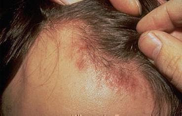 себорейный сухой дерматит на голове лечение