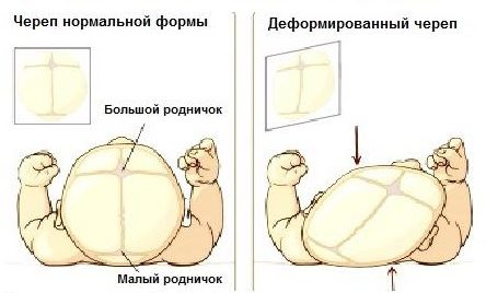 ΠΡΠ°Π²ΠΈΠ»ΡΠ½Π°Ρ ΠΈ Π½Π΅ΠΏΡΠ°Π²ΠΈΠ»ΡΠ½Π°Ρ ΡΠΎΡΠΌΠ° ΡΠ΅ΡΠ΅ΠΏΠ° Π½ΠΎΠ²ΠΎΡΠΎΠΆΠ΄Π΅Π½Π½ΠΎΠ³ΠΎ ΡΠ΅Π±Π΅Π½ΠΊΠ°, Π²ΠΈΠ΄Ρ Π΄Π΅ΡΠΎΡΠΌΠ°ΡΠΈΠΈ Π³ΠΎΠ»ΠΎΠ²ΠΊΠΈ β ΡΡΠΎ ΡΠ²Π»ΡΠ΅ΡΡΡ ΠΏΠ°ΡΠΎΠ»ΠΎΠ³ΠΈΠ΅ΠΉ?